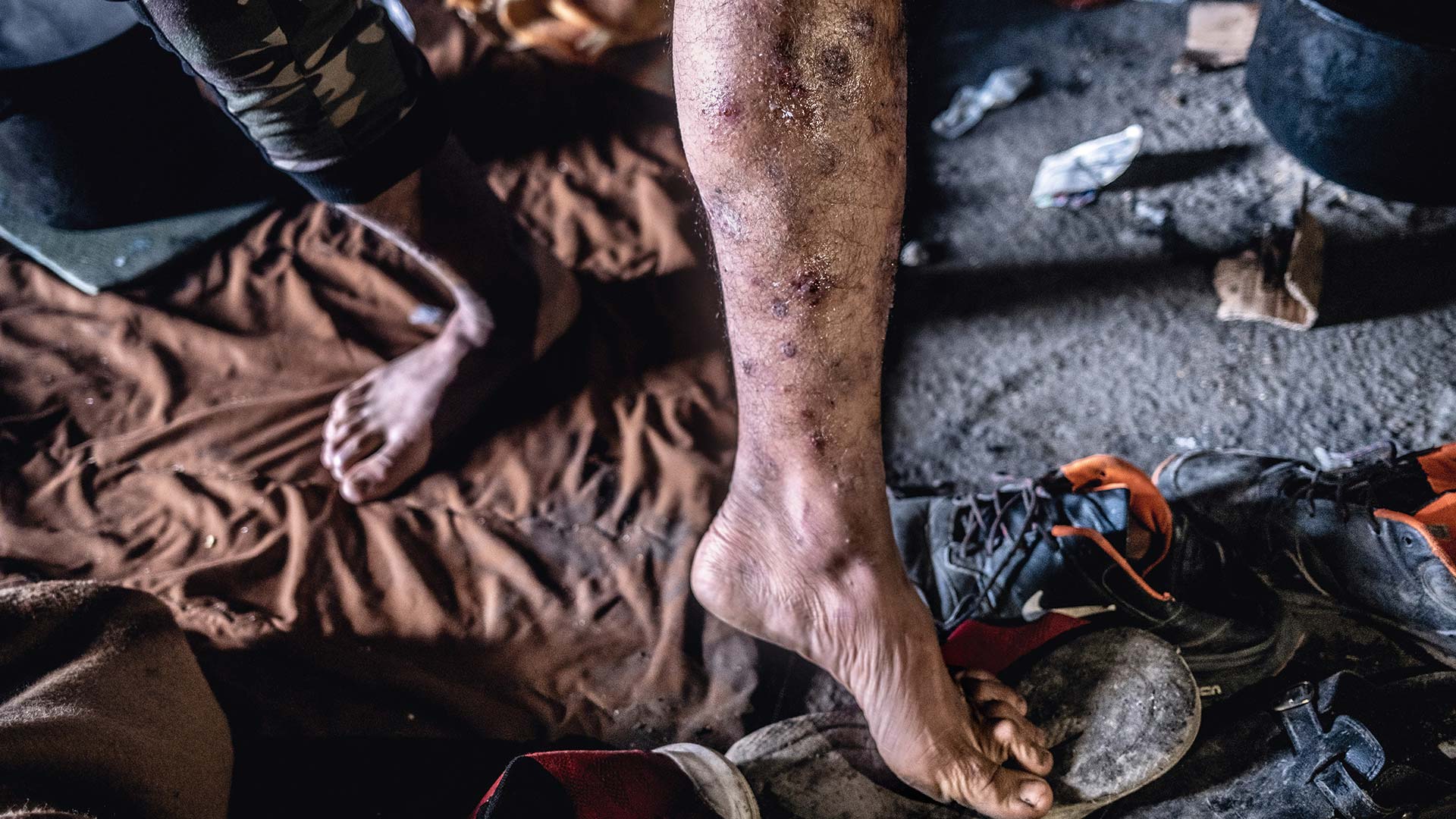 Spuren der Gewalt: Ein Geflüchteter zeigt sein Bein, nachdem er von kroatischen Grenzpolizisten gefasst, verletzt und nach Bosnien zurückgeschickt wurde. 
