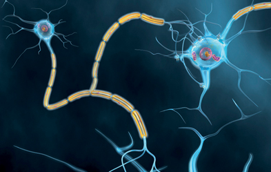 Aktive Nervenzellen mit Axon, Myelin, Dendriten und Synapsen. Bei Demenzkranken bilden sich Eiweißablagerungen, so dass die Kommunikation und Versorgung der Nervenzellen verhindert wird. Illustration: ddp